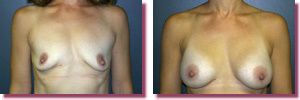 Breast Augmentation Before and After