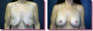 Mastopexy Before and After