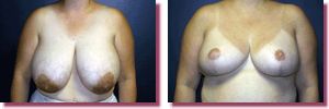Breast Reduction Before and After